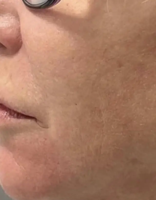 Lower cheek after a laser series, texture smoother