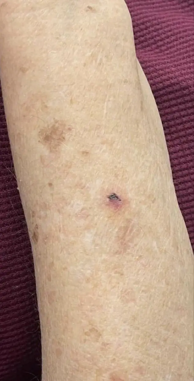 Forearm after resurfacing, the brown sun spots lightened
