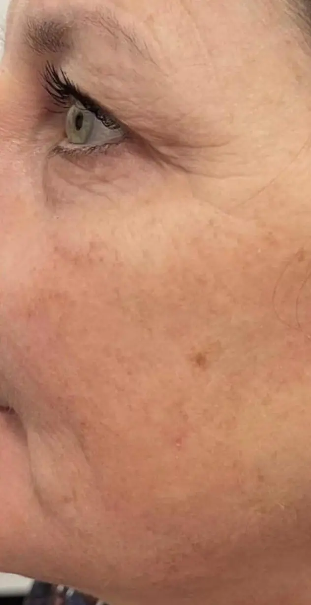 The same eye area after, crow's feet softened