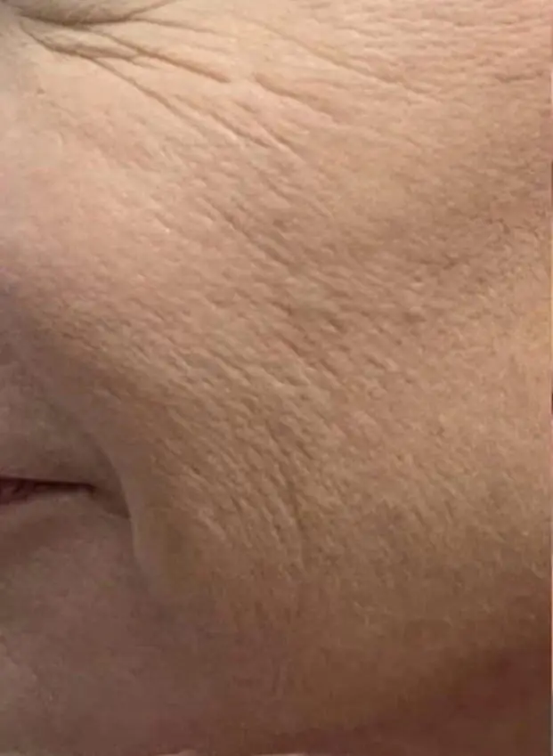 Lower cheek before treatment, fine lines and crepey texture