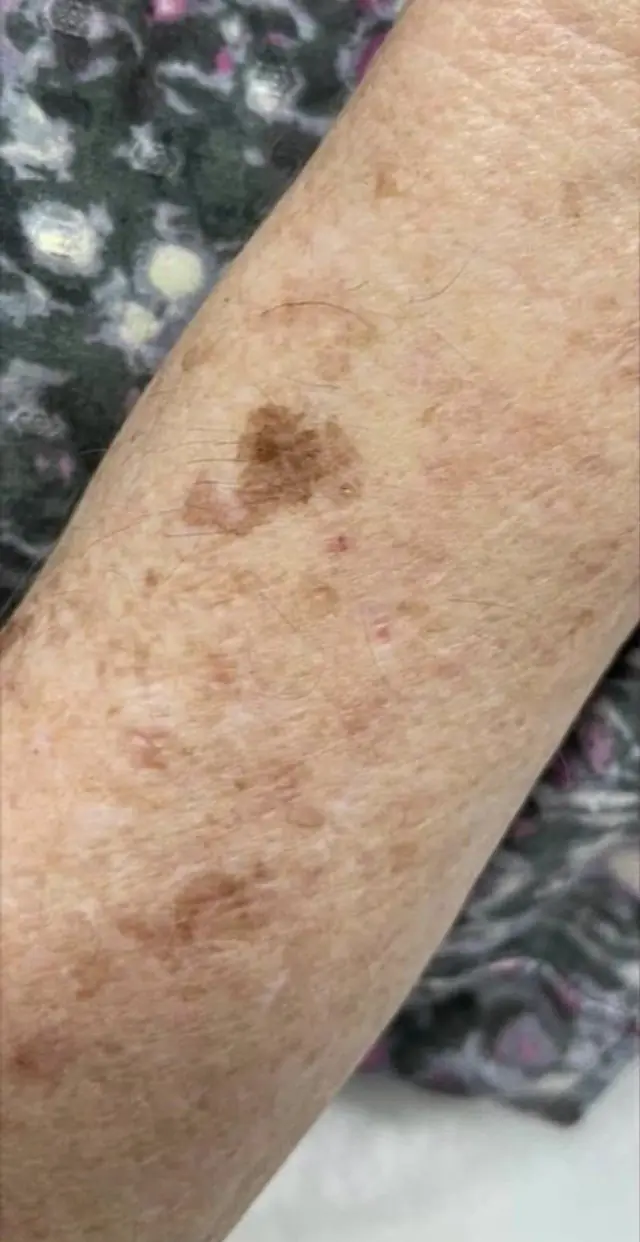 Forearm before treatment, scattered brown sun spots