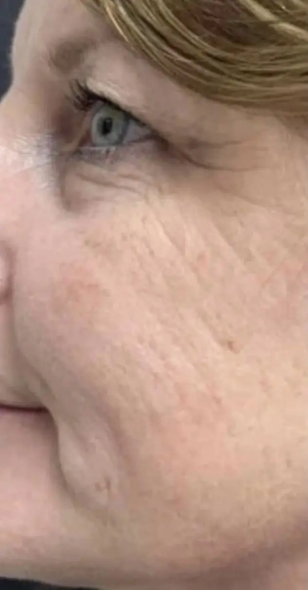 Eye area before treatment, crow's feet and fine lines